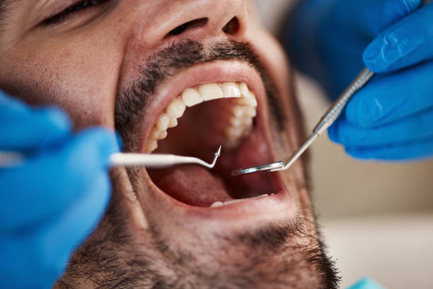 Best Emergency Tooth Extraction in Beverly Hills, TX