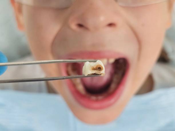 Best Emergency Wisdom Teeth Removal in Beverly Hills, TX